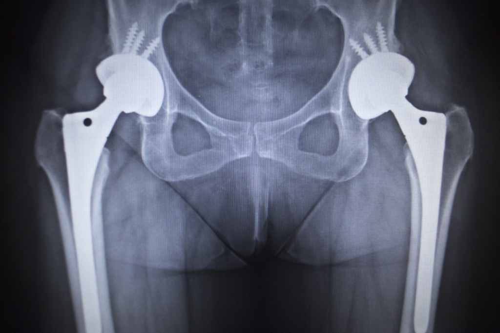 The Anatomy Of The Hip Joint Replacement Surgery