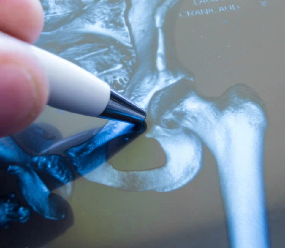 Hip Replacement Surgery - Advanced orthopaedic procedures