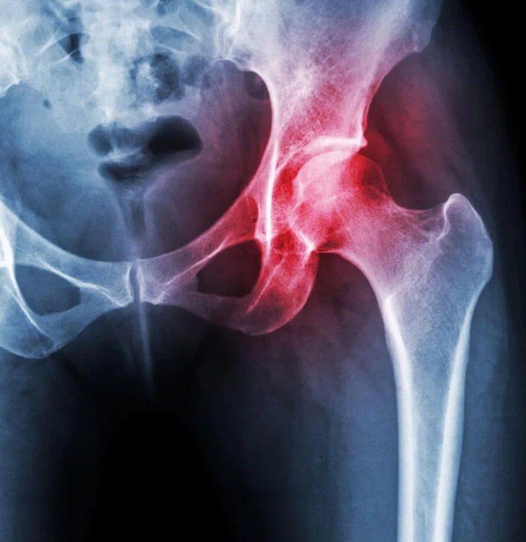 Hip Anatomy and Replacement