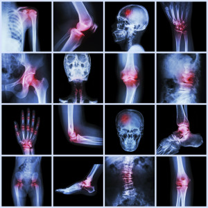 Collection human joint and arthritis and stroke